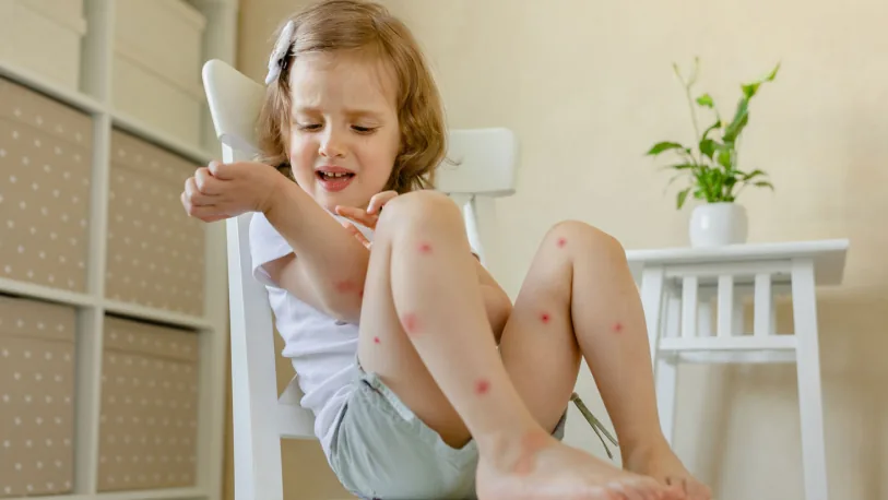 Child with mosquito bites on her legs scratching
